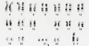Imagen: Cariotipo de la trisomía que produce el síndrome de Down (Fotografía cortesía de la colección Wellcome).